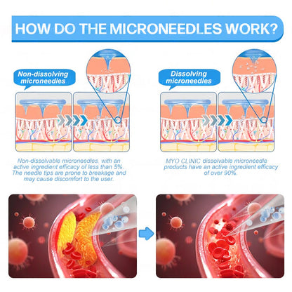 🇺🇸FDA Official Store | Myo Clinic GLP-1 Slim & Firm Nano Microneedle Patch with Collagen, Turmeric & Matrixyl 3000丨Obesity, Cardiovascular Disease, Diabetes, Sleep Apnea, Joint Problems and More